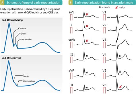 st elevation vs early repolarization.